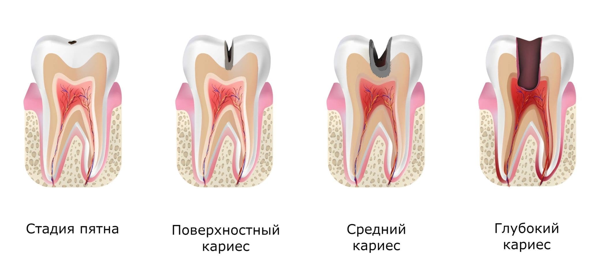 Глубокий кариес при беременности