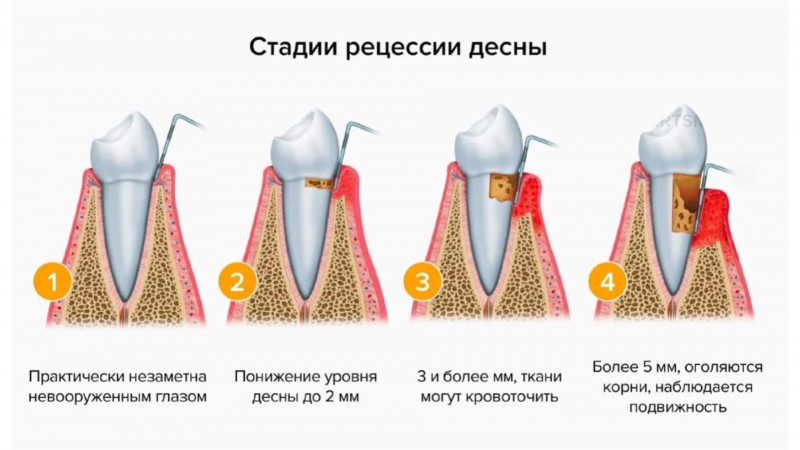 Осложнения рецессии десны - фото примеров