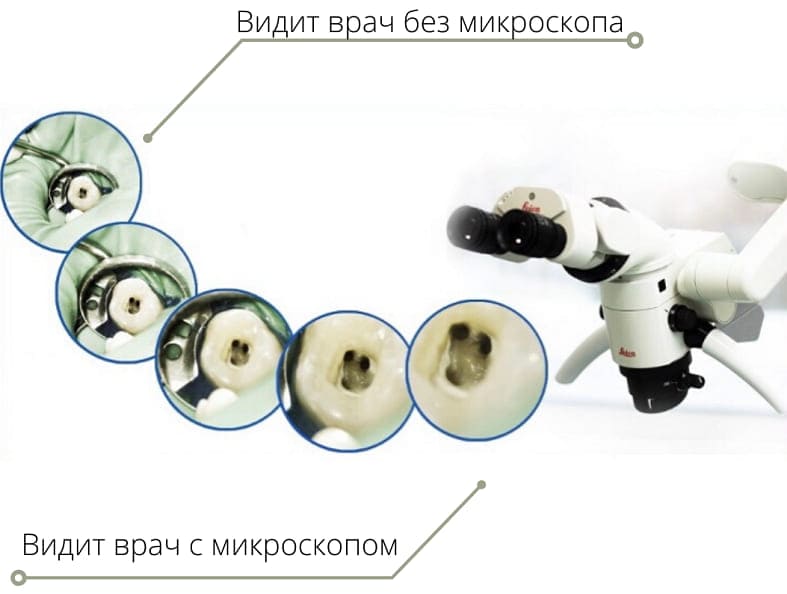 Лечение зубов под микроскопом в клинике Леви-Дент